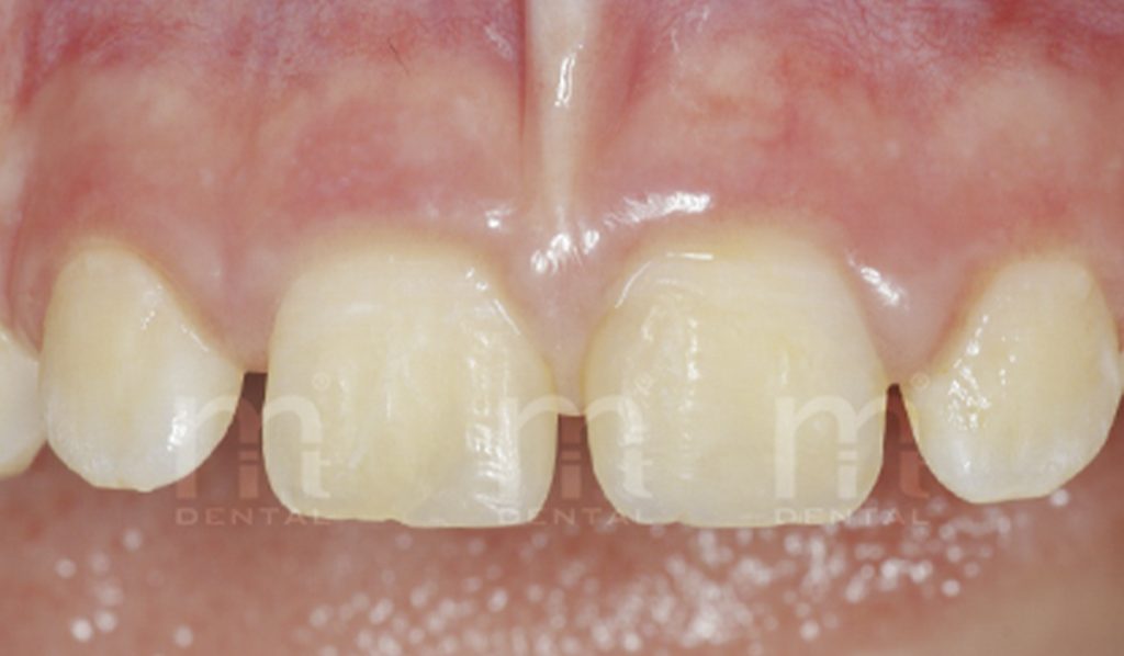 Traumatismo dental en niños. Mit dental.